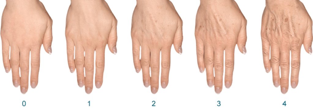 An image displaying 5 versions of how the same hand. Revealing how the DERMAGLOVE Skin Line rejuvenated skin tone over time.