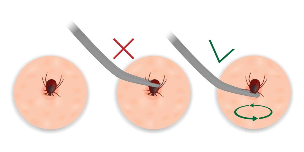 Removing a tick with tweezers